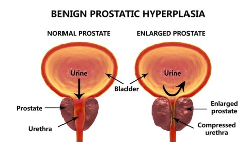 Prostatitis fibroids prosztata változások