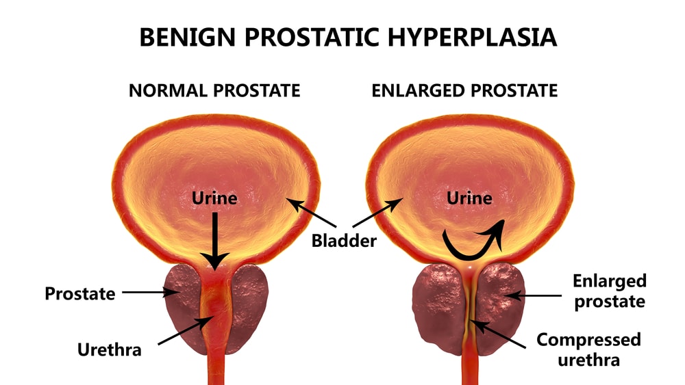 Prostatitis a férfiak órájában Teljes húgyhólyag prosztatitis